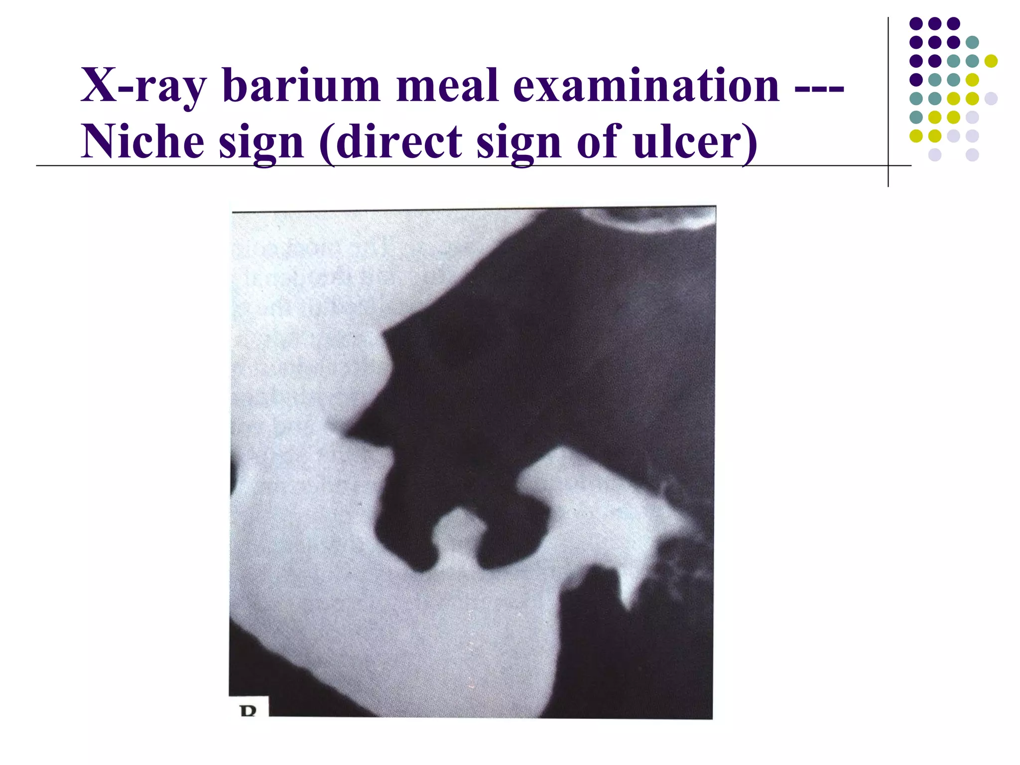X-ray barium meal examination --- Niche sign (direct sign of ulcer) 