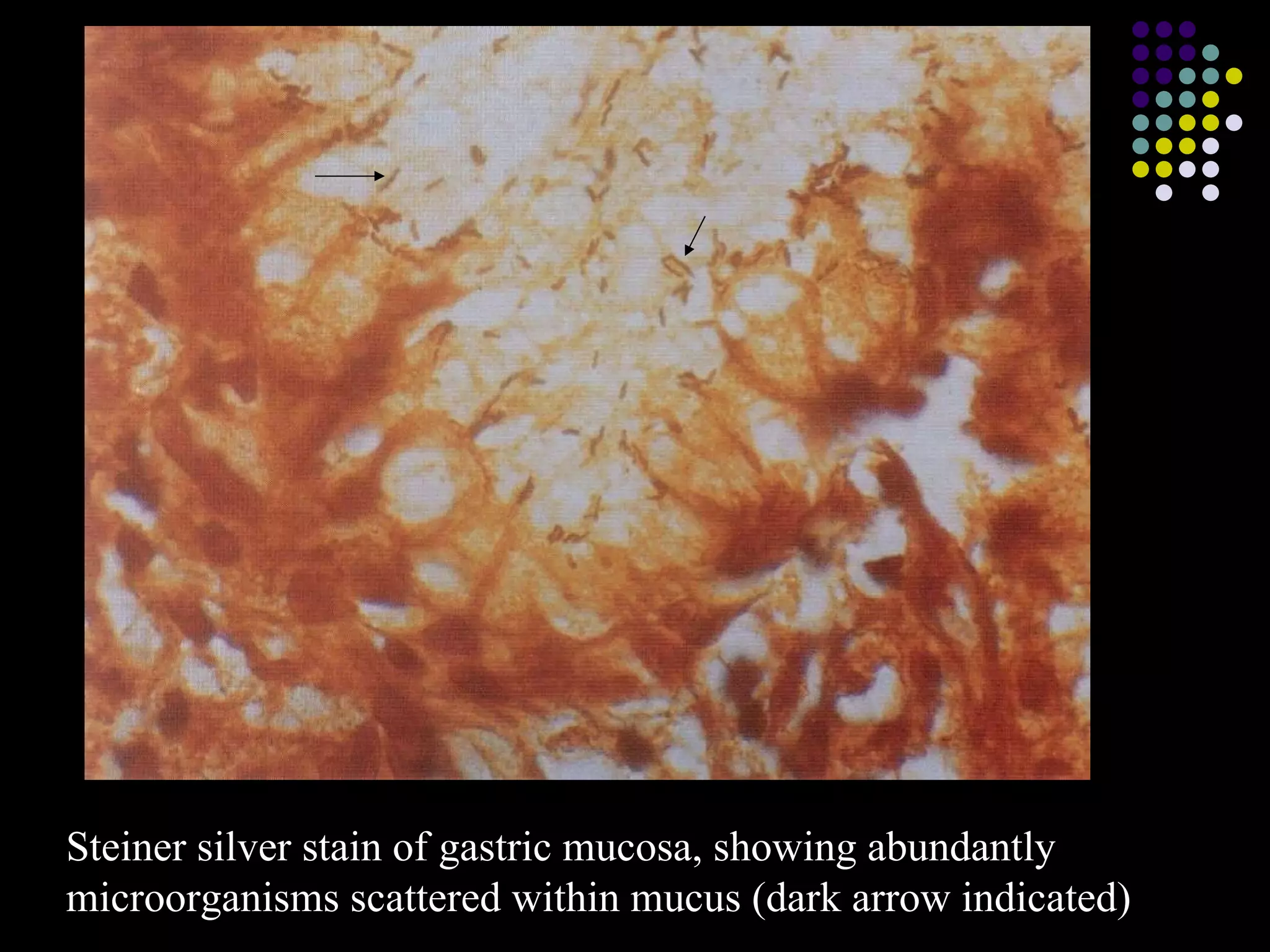 Steiner silver stain of gastric mucosa, showing abundantly  microorganisms scattered within mucus (dark arrow indicated) 