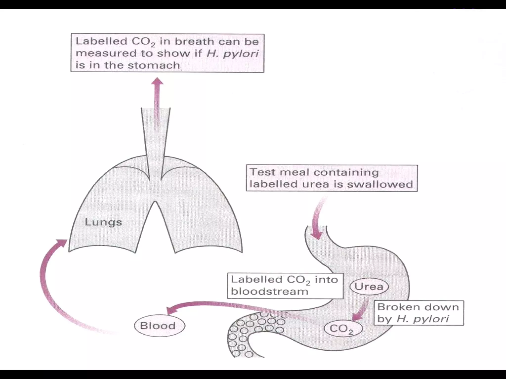 13C Urea Breath Test (UBT) 