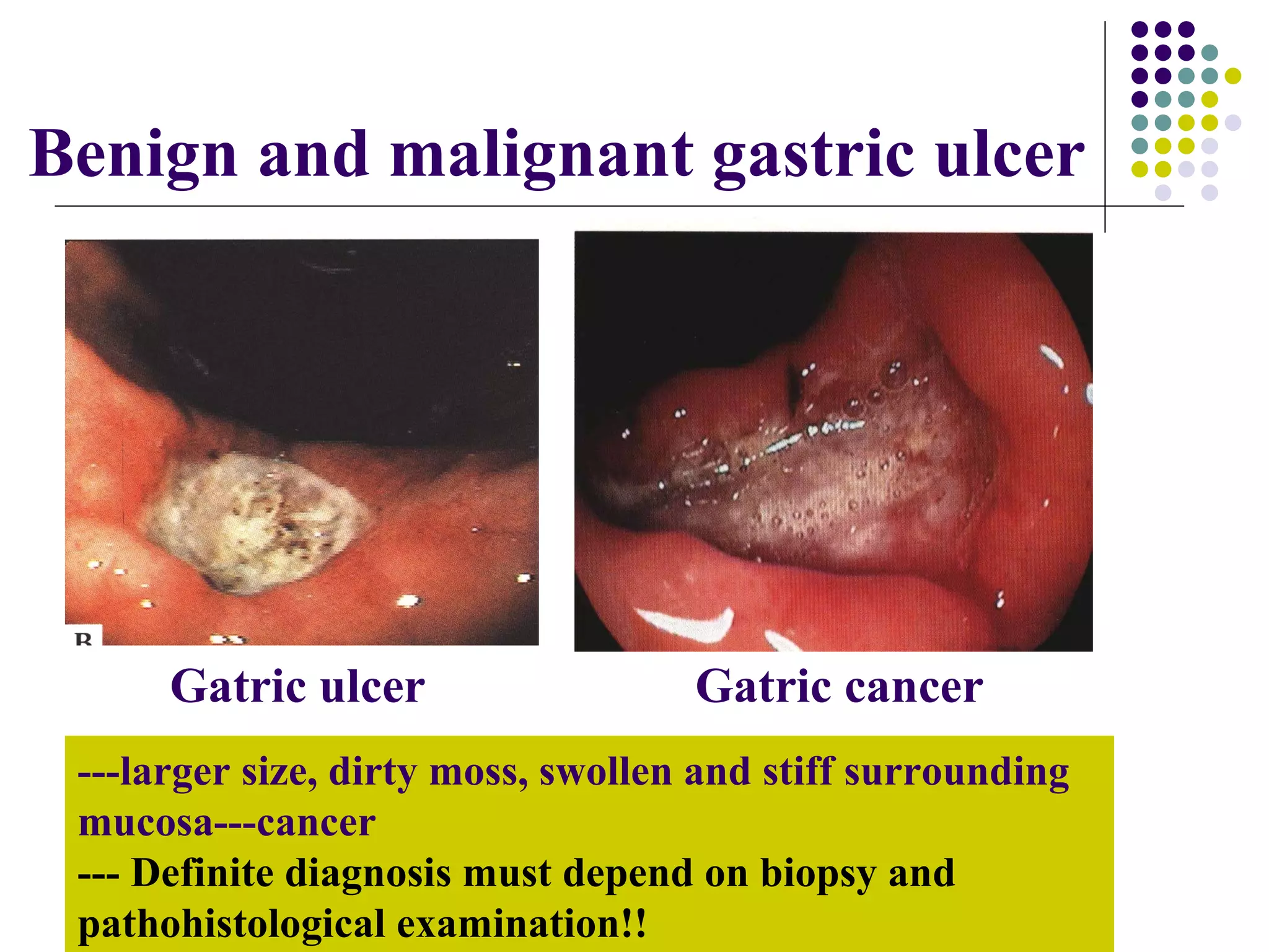 ---larger size, dirty moss, swollen and stiff surrounding   mucosa---cancer --- Definite diagnosis must depend on biopsy and pathohistological examination!! Gatric ulcer  Gatric cancer Benign and malignant gastric ulcer 