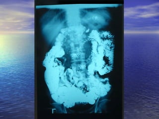 18 transito intestinal