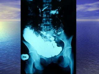 18 transito intestinal