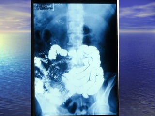 18 transito intestinal