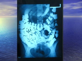 18 transito intestinal