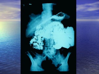 18 transito intestinal