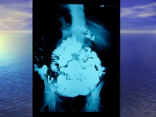 18 transito intestinal