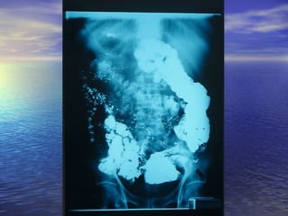 18 transito intestinal