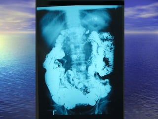 18 transito intestinal