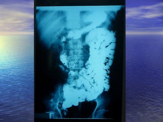 18 transito intestinal