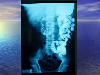 18 transito intestinal