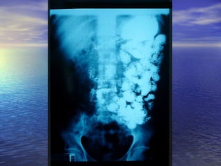 18 transito intestinal