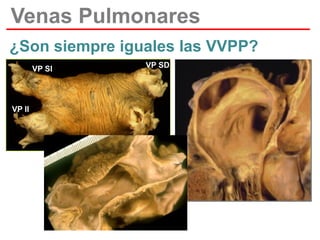 Venas Pulmonares
¿Son siempre iguales las VVPP?
VP SI

VP SD

VP II

VP ID

 