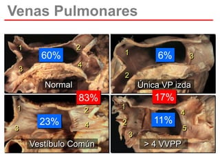 Venas Pulmonares
1

2

1

60%

3

4

3

2

Normal

Única VP izda

17%

83%
2

1

3

6%

23%

1

4

2

11%

4
5

3

Vestíbulo Común

> 4 VVPP

 