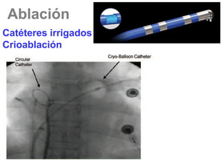 Ablación
Catéteres irrigados
Crioablación

 