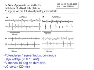 •Potenciales fragmentados, continuos
•Bajo voltaje (< 0.15 mV)
•Al menos 10 seg de duración.
•LC corta (120 ms)

 