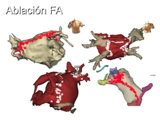 Ablación FA

 