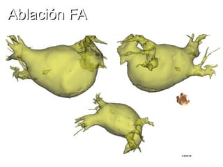 Ablación FA

 