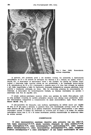 A paciente , so b anestesi a gera l e e m decúbit o ventral , fo i submetid a a laminotomi a
osteoplástica d e C l a C 4 atravé s d e drilage m da s lâmina s à E e fratur a e m «galh o verde » à
direita ( D ) . A dura-máte r s e apresentav a tens a e nã o pulsátil ; fo i abert a e m sentid o longi -
tudinal e observad a lesã o tumora l cístic a d e co r acinzentad a e d e localizaçã o ântero-latera l
à B , estendendo-s e d e C l a C 4 e deslocand o a medul a par a a D . Co m lev e retraçã o d a medul a
e so b visã o magnificad a a lesã o fo i facilment e dissecad a desfazendo-s e pequen a (aderênci a dura i
anterior e totalment e extirpad a e m bloco . Nã o fo i observad a presenç a d e comunicaçõe s ex -
tradurais. A dura-máte r fo i hermeticament e fechada , a s lâmina s recolocada s e m posiçã o e
amarradas co m fio s d e algodã o zero .

      O estud o anátomo-patológic o mostro u «Cist o co m parede s d e tecid o fibro-adipos o ond e
se not a cavidad e revestid a d e epitéli o prismátic o simple s co m célula s muc o produtoras . Acha -
dos microscópico s compatívei s a remanescente s d o cana l neuroentérico » (Lab . Paul o Borges .
Exame 384/89 ) ( F i g . 2) .

       O pós-operatóri o fo i tranquilo , co m melhor a significativ a d o défici t moto r po r ocasiã o
da alt a n o 3 * di a apó s a cirurgia . A pacient e fico u co m imobilizaçã o cervica l (cola r d e Tho -
mas) durant e 6 0 dias , quand o j á s e achav a totalment e recuperada , assintomátic a e co m exam e
neurológico normal . O mesm o fo i observad o n o control e co m 1 2 mese s e 1 8 meses . O s estudo s
radiológicos feito s co m 2 , 1 2 e 1 8 mese s mostrara m perfeit a reconstituiçã o d o arcabouç o ósse o
da colun a cervical .

                                            COMENTÁRIOS

       O cist o neuroentéric o espinhal , descrit o pel a primeir a ve z e m 1934 1.10,
tem vast a sinoními a 6,15,18,22 , send o també m chamad o d e cist o entéric o 6.14,22,
cisto enterogênic o 16,22 , cist o teratomatos o *M, gastrocitom a H i 7 , cist o entero -
gênico intraespinha l 8.11 , cist o neuroentéric o intraespinha l ^.i*, cist o congênit o
entérico intraespinha l is cist o enterógeno? . É u m tumo r embrionári o d e loca -
                              e
 