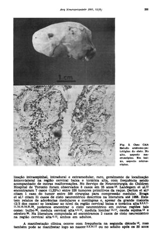 lização intraespinhal , intradura l e extramedular , raro , geralment e d e localizaçã o
ântero-lateral n a regiã o cervica l baix a e torácic a alta , co m frequênci a send o
acompanhado d e outra s malformações . N o Serviç o d e Neurocirurgi a d o Childre n
Hospital d e Toront o fora m observado s 8 caso s e m 2 5 anos ». Landege m e t ál.
                                                                       1                                  12



encontraram 7 caso s (1,32% ) entr e 52 8 tumore s primitivo s d a raque . Derlon e t slfi
citam 1 cas o d o tumo r entr e 50 0 cirurgia s par a compressã o medular . Brag a
et ai. cita m 5 1 caso s d è cist o neurentérie o descrito s n a literatur a at é 1988 . Exis
      1                                                                                                       i



tem relato s d e aderência s medulare s e meníngea s e , apesa r d a grand e maiori a
(2/3 do s casos ) s e localiza r a o níve l d a regiã o cervica l baix a e torácic a alta » » ' -
                                                                                             2   3    5   7



ii,i5,i6,i8,2i,22 podemo s encontra r o cist o neurentérie o e m outra s regiõe s tai s
como: bulb o 20, medul a cervica l alt a 4,6,13, medul a lomba r caud            a equina e          12



cérebro 20. N a literatur a computad a s ó encontramo s 2 caso s d e cist o neurentérie o
na regiã o cervica l alta^ , ambo s e m adultos .
                             13




     A manifestaçã o clínic a ocorr e co m frequênci a n a segund a década , ma s       12



também pod e s e manifesta r log o a o nasee r 2,3,16,1 7 o u n o adult o apó s o s 5 0 ano s
 