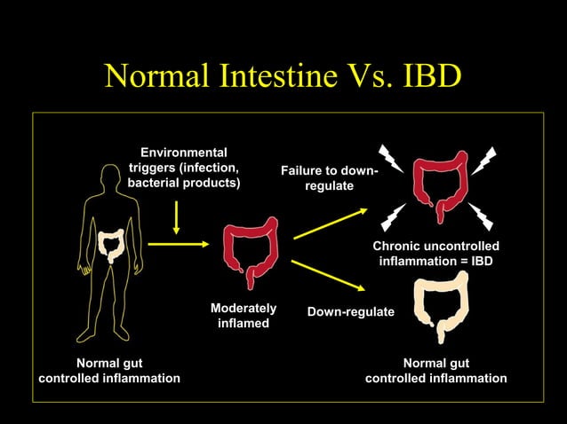 Ulcerative Colitis PPT