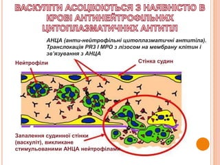 Нейтрофіли Стінка судин
АНЦА (анти-нейтрофільні цитоплазматичні антитіла).
Транслокація PR3 I MPO з лізосом на мембрану клітин і
зв’язування з АНЦА
Запалення судинної стінки
(васкуліт), викликане
стимульованими АНЦА нейтрофілами
 
