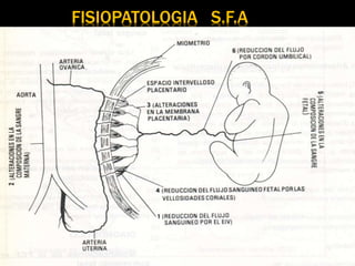 FISIOPATOLOGIA S.F.A
 