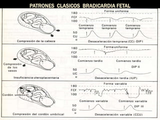 PATRONES CLASICOS BRADICARDIA FETAL
 