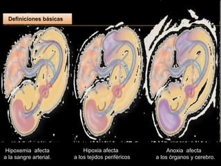 Hipoxemia afecta
a la sangre arterial.
Hipoxia afecta
a los tejidos periféricos
Anoxia afecta
a los órganos y cerebro.
 