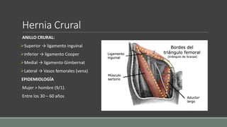Hernia Crural
ANILLO CRURAL:
Superior → ligamento inguinal
Inferior → ligamento Cooper
Medial → ligamento Gimbernat
Lateral → Vasos femorales (vena)
EPIDEMIOLOGÍA
Mujer > hombre (9/1).
Entre los 30 – 60 años
 