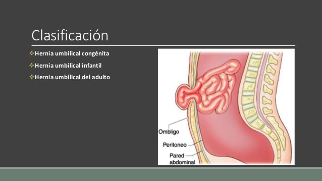 19.hernias abdominales