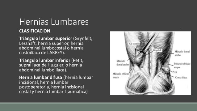 19.hernias abdominales