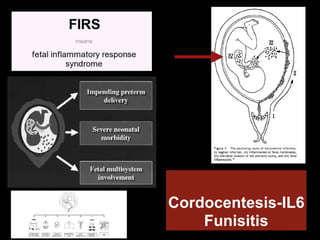 Funisitis Inflamación e infección intraamniótica y parto pretérmino. Certezas y ...