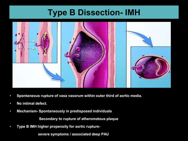 Type B AORTIC DISSECTION | PPT