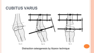 CUBITUS VARUS
Distraction osteogenesis by Ilizarov technique
 