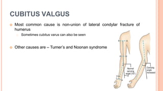 CUBITUS VALGUS
 Most common cause is non-union of lateral condylar fracture of
humerus
Sometimes cubitus varus can also be seen
 Other causes are – Turner’s and Noonan syndrome
 