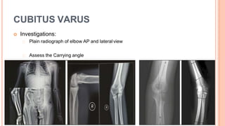 CUBITUS VARUS
 Investigations:
Plain radiograph of elbow AP and lateral view
Assess the Carrying angle
 