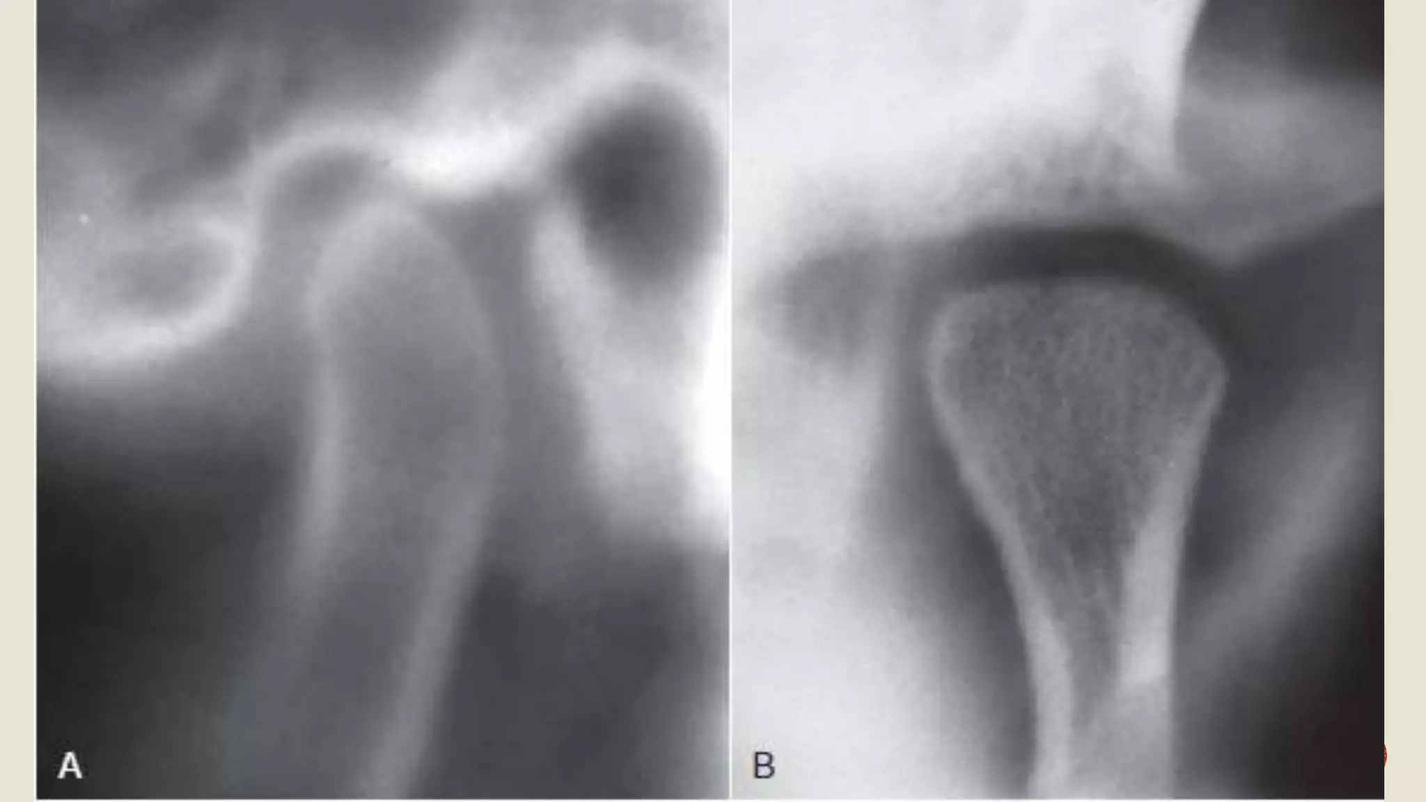 Radiographic Features of Temporomandibular Joint and Disorders | PPTX