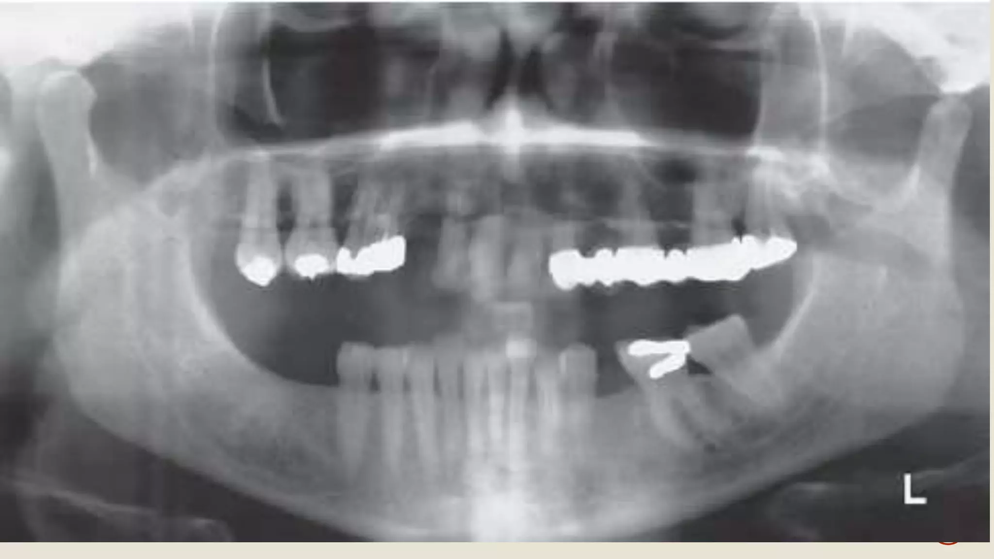 Radiographic Features of Temporomandibular Joint and Disorders | PPTX
