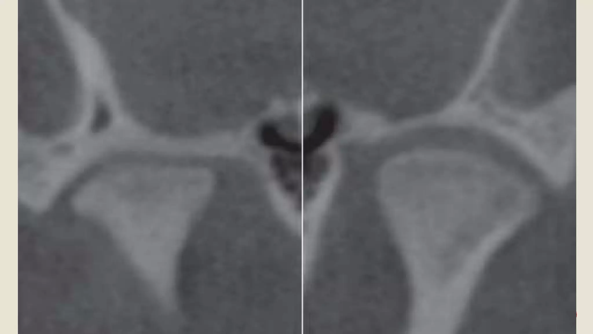 Radiographic Features of Temporomandibular Joint and Disorders | PPTX