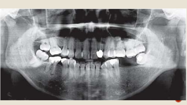 Radiographic Features of Temporomandibular Joint and Disorders | PPTX ...
