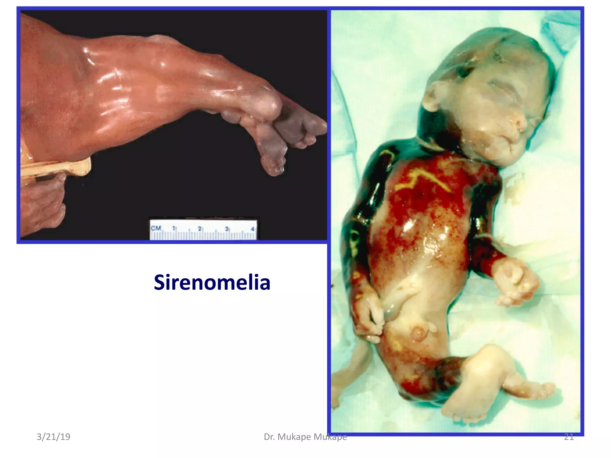 Sirenomelia
3/21/19 Dr. Mukape Mukape 21
 