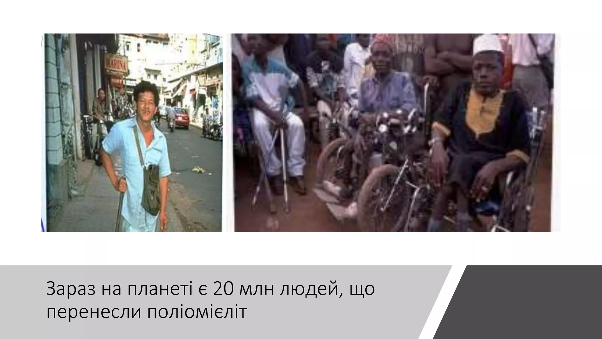 Зараз на планеті є 20 млн людей, що
перенесли поліомієліт
 