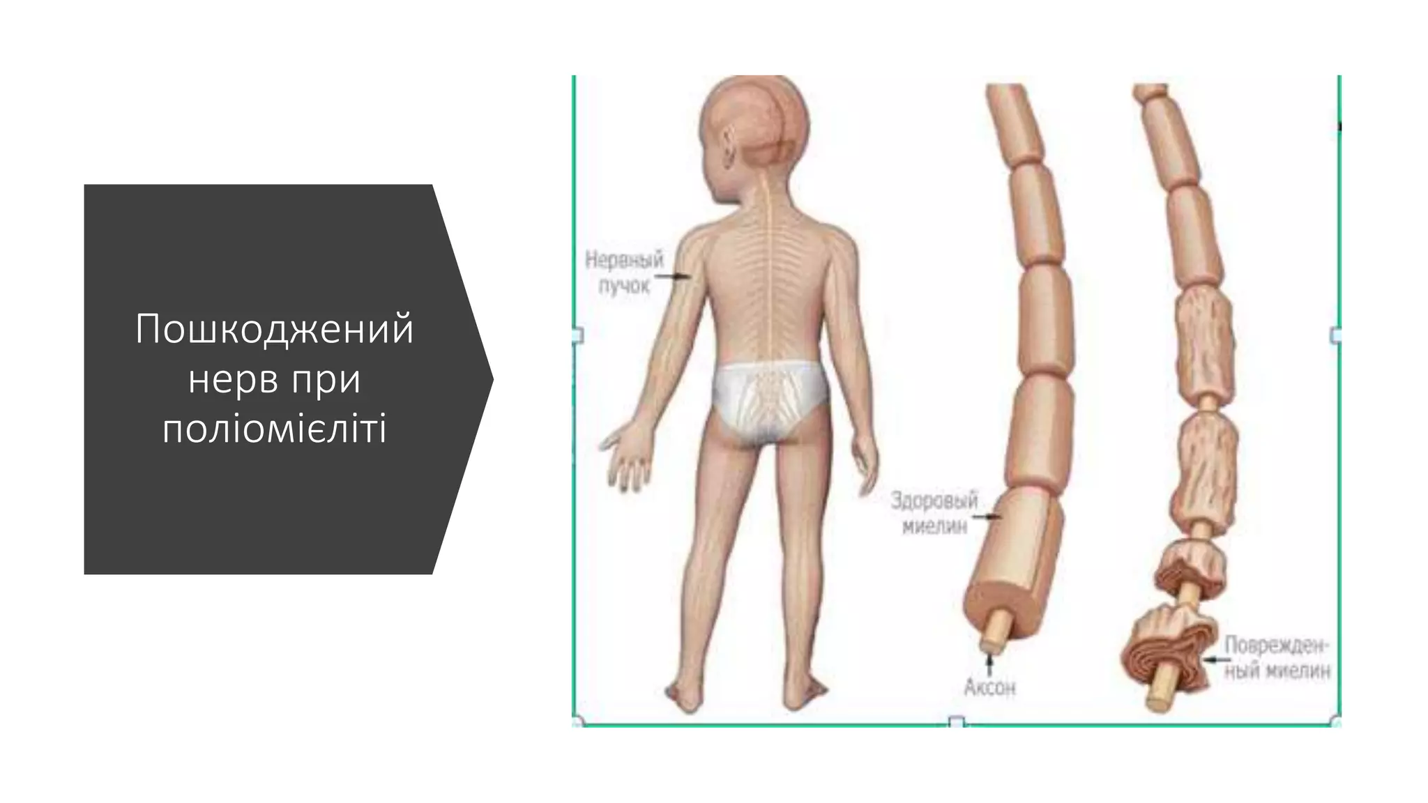 Пошкоджений
нерв при
поліомієліті
 