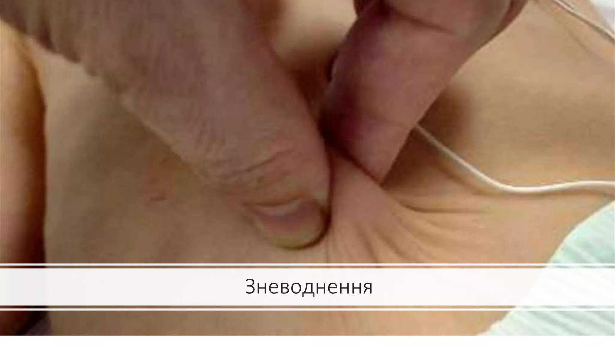 Зневоднення
 