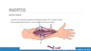 INJERTOS
ARTERIA RADIAL
◦ Incisión 2cm proximal al apófisis estiloides del radio  2 cm distal al codo.
◦ Nervio antebraquial lateral y rama superficial del nervio radial.
Cohn, L. H. Cardiac Surgery in the Adult, 2009 4ª. Ed. 2012
 