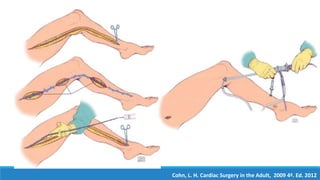 Cohn, L. H. Cardiac Surgery in the Adult, 2009 4ª. Ed. 2012
 