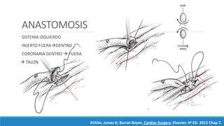 ANASTOMOSIS
SISTEMA IZQUIERDO
INJERTO FUERADENTRO
CORONARIA DENTRO  FUERA
 TALON
Kirklin, James K; Barrat-Boyes. Cardiac Surgery. Elsevier. 4ª ED. 2013 Chap 7.
 