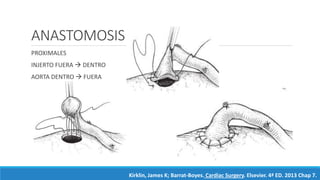 ANASTOMOSIS
PROXIMALES
INJERTO FUERA  DENTRO
AORTA DENTRO  FUERA
Kirklin, James K; Barrat-Boyes. Cardiac Surgery. Elsevier. 4ª ED. 2013 Chap 7.
 