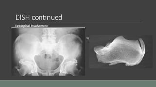Enthesis On Radiograph Arthritis in children and young adult - overview | PPTX
