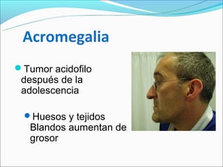 Acromegalia
Tumor acidofilo
 después de la
 adolescencia

 Huesos y tejidos
   Blandos aumentan de
   grosor
 